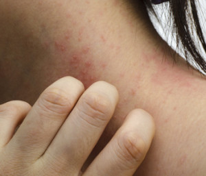 Psoriasis And Eczema Treatment In Red Bluff, California