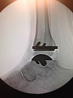 Total Ankle Replacement In Redding