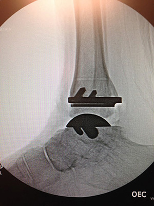 Total Ankle Replacement In Redding