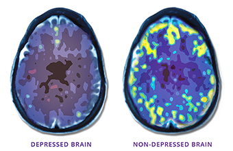 Depression Treatment in Redding, NeuroStar TMS