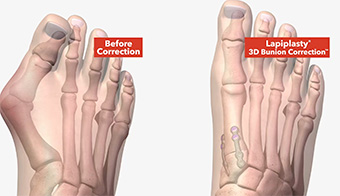 Lapiplasty Bunion Surgery: Bunion Treatment In Redding