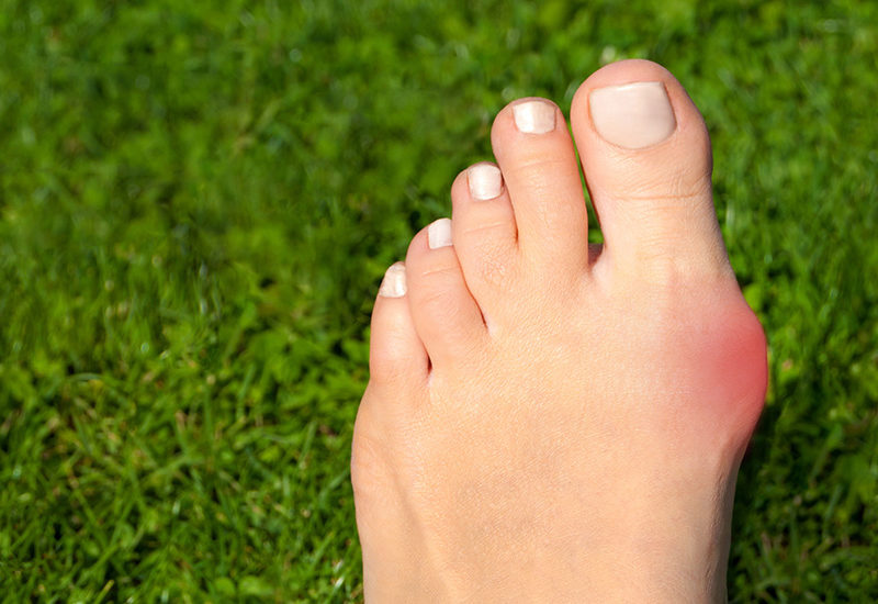 Lapiplasty Bunion Surgery