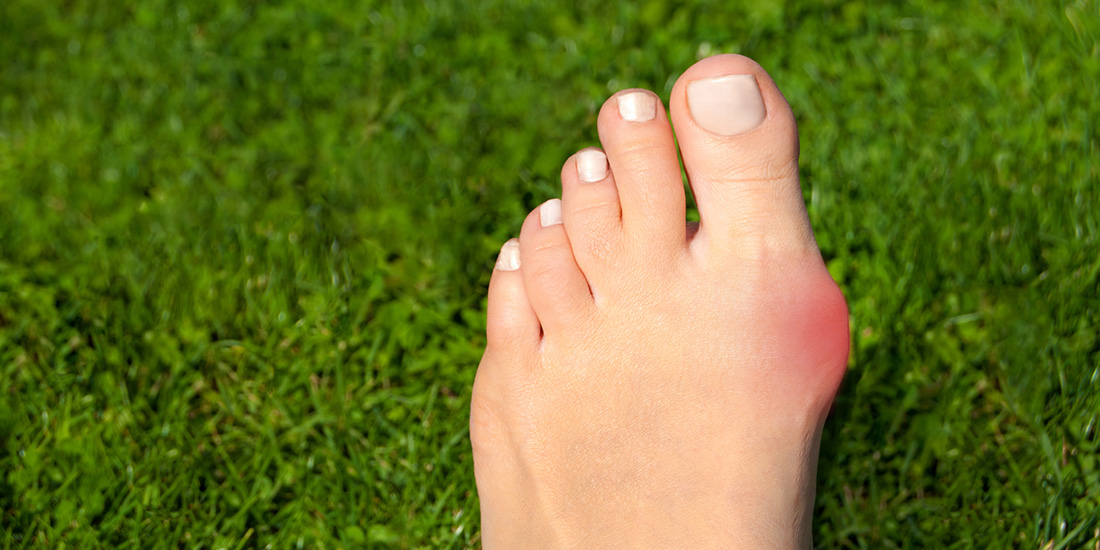 Lapiplasty Bunion Surgery